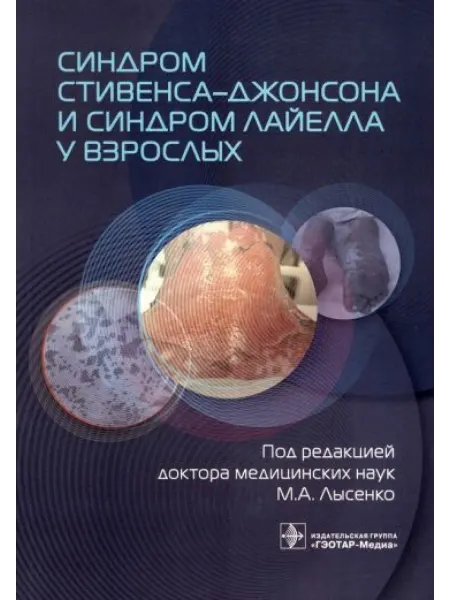 ГЭОТАР-Медиа Синдром Стивенса–Джонсона и синдром Лайелла у взрослых