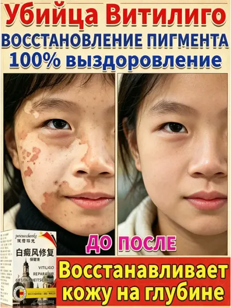 Крем для лечения белых пятен при витилиго