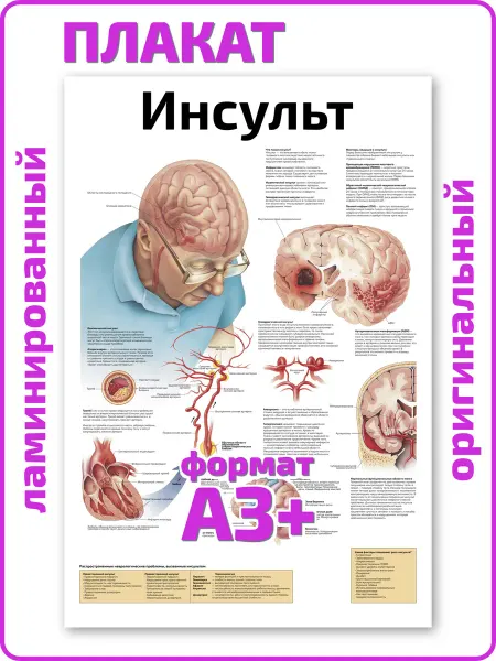 Квинг Инсульт анатомический медицинский плакат А3 ламинированный