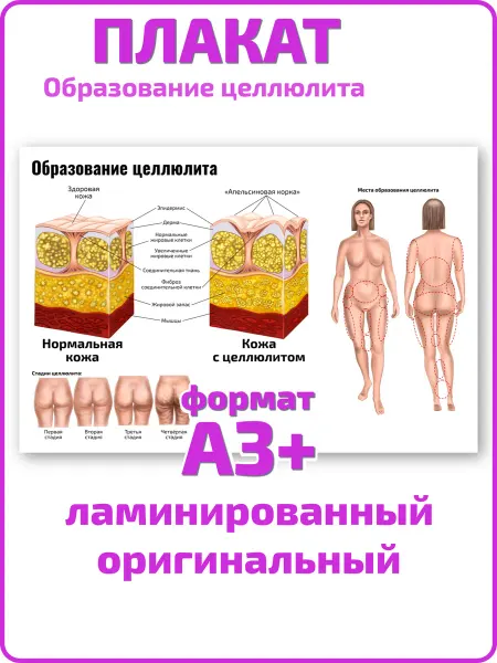 Квинг Образование целлюлита массажу плакат А3 ламинированный