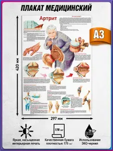 Информационный медицинский плакат "Артрит" / А-3 (30x42 см.)