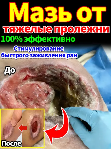Спрей от пролежней для лежачих больных с серебром