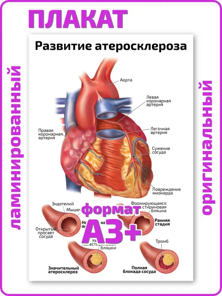 Квинг Развитие атеросклероза медицинский плакат А3 ламинированный